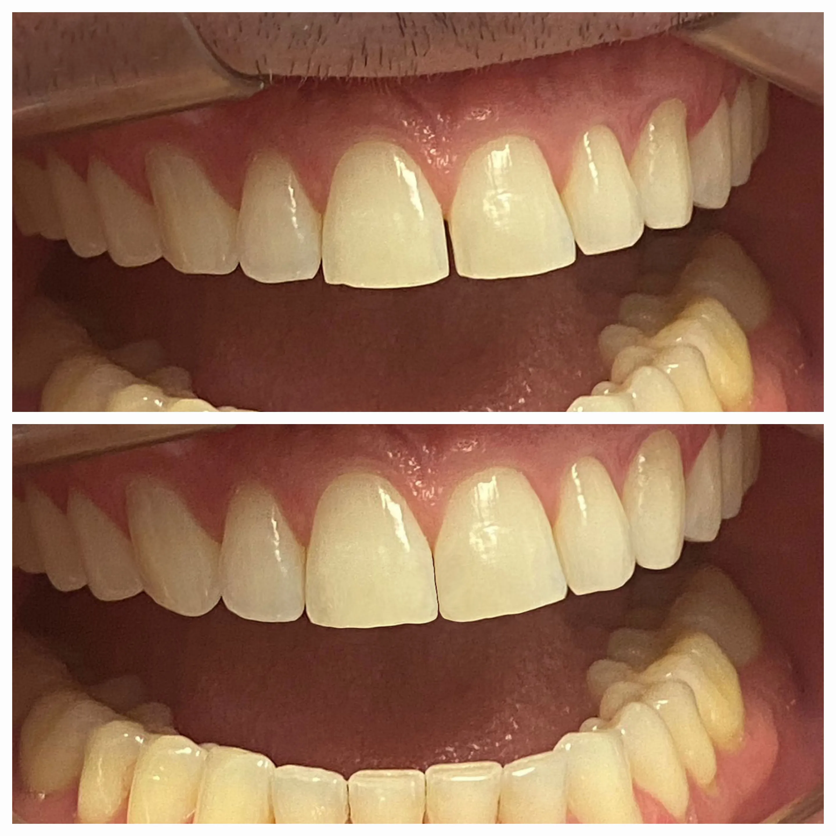 Antes e depois de tratamento odontológico 1