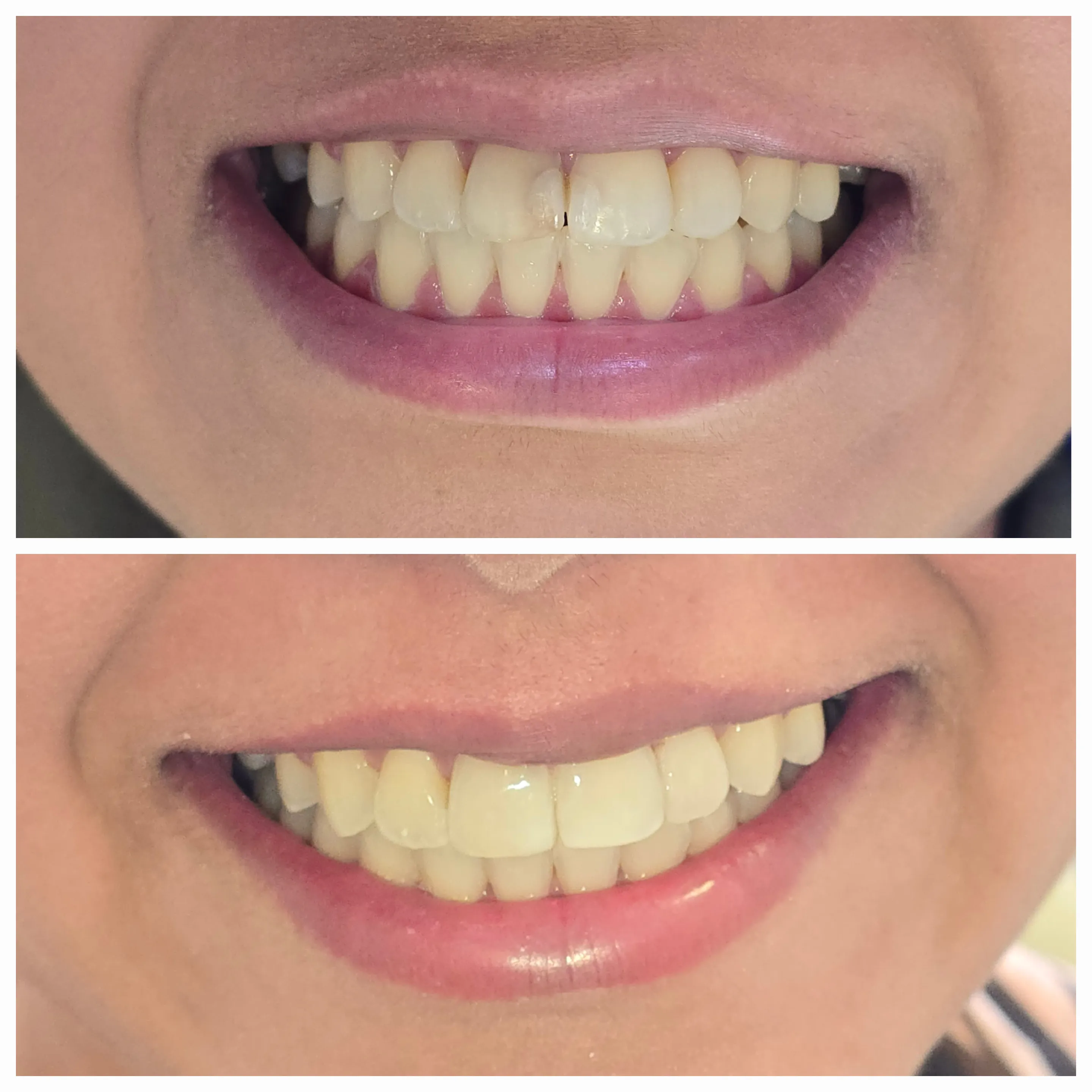 Antes e depois de tratamento odontológico 2