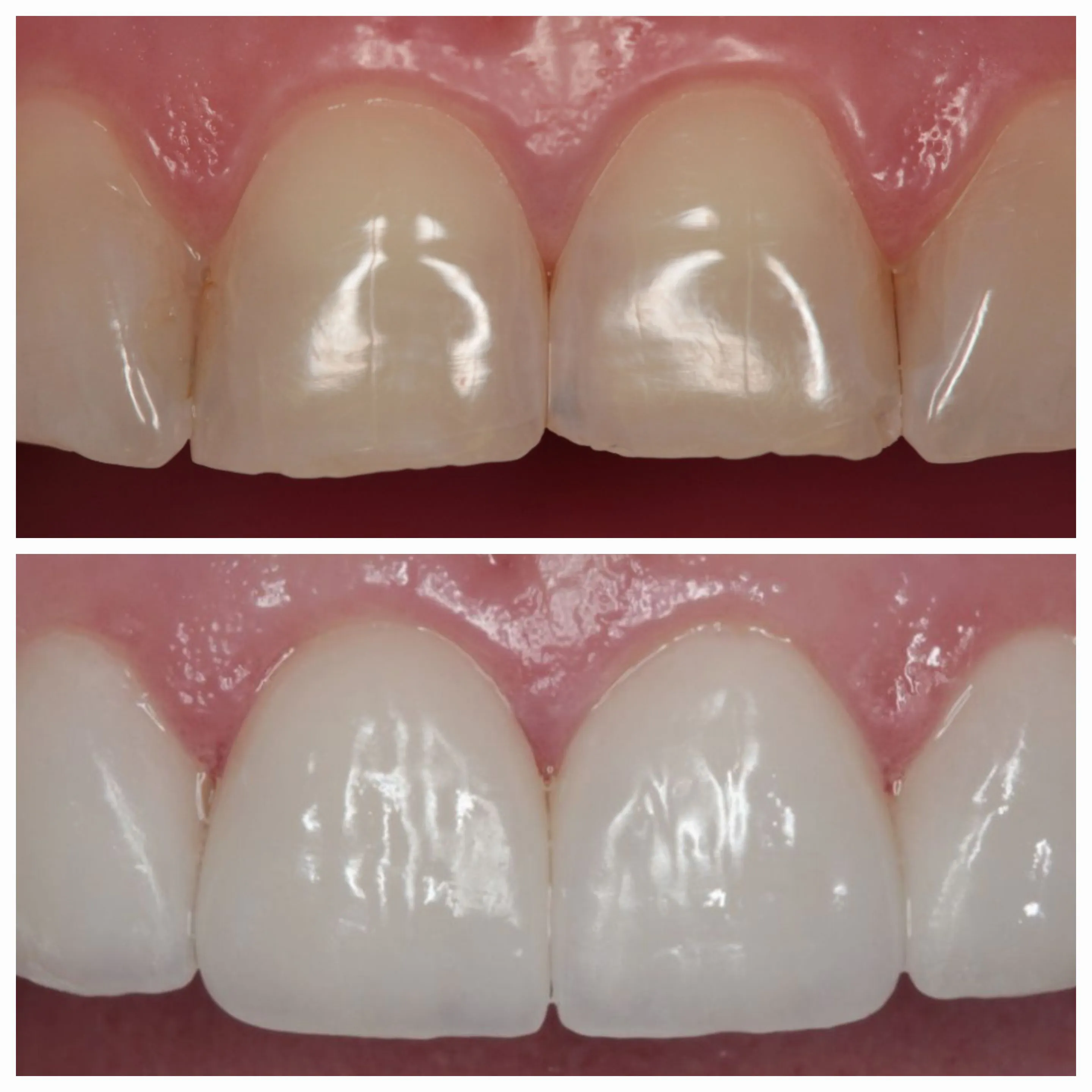 Antes e depois de tratamento odontológico 5